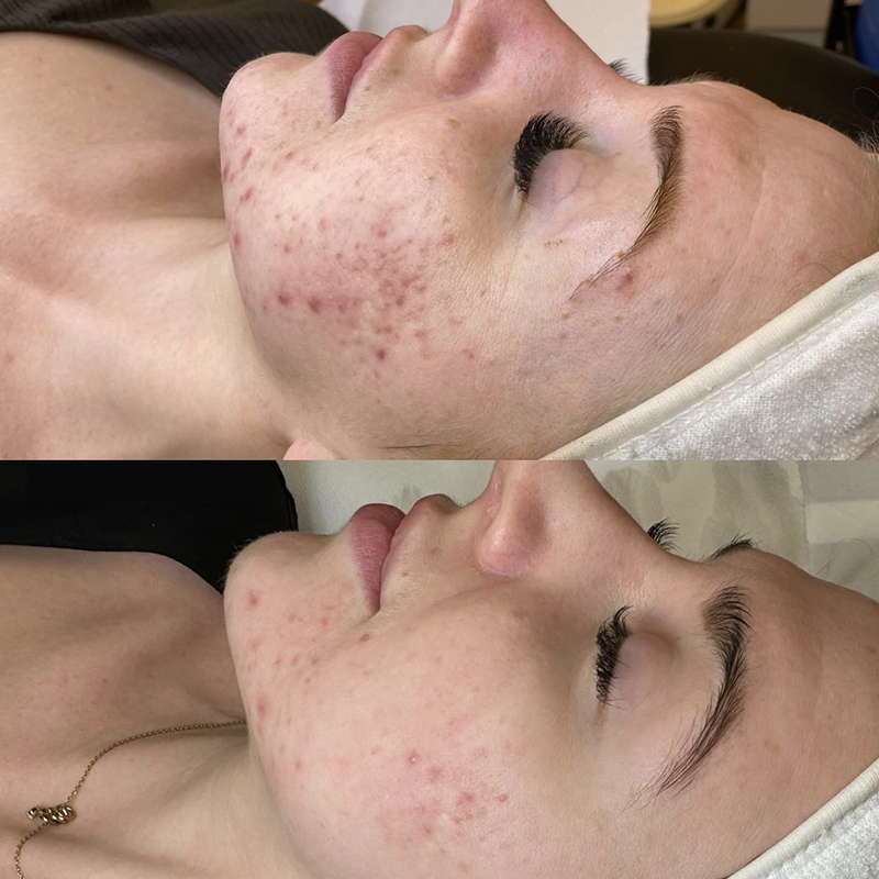 Programme Acne Control